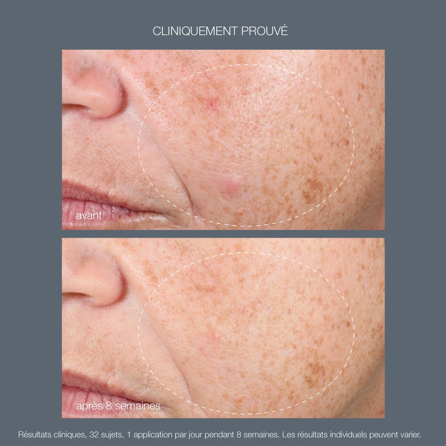 Avant-après - huile de nuit purifiante au rétinol - Dermalogica - Marine Lemaitre Skincare - Soin Peau Nantes