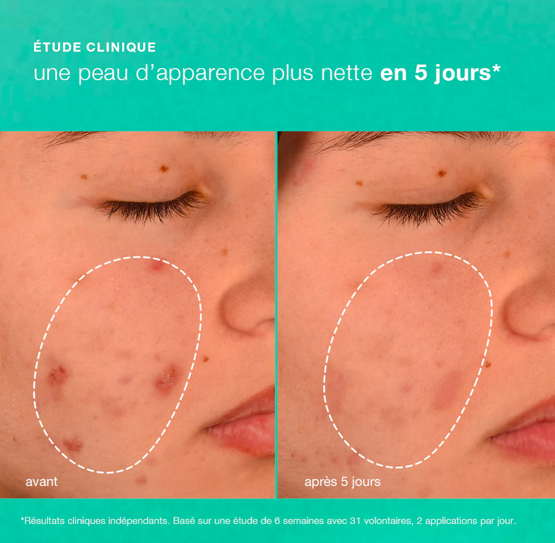 Breakout Biotic Moisturizer - Crème de jour anti-imperfections Dermalogica