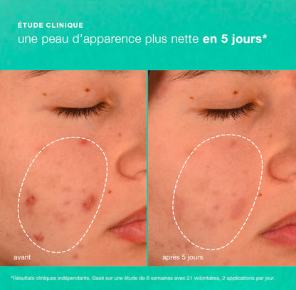 Breakout Biotic Moisturizer - Crème de jour anti-imperfections Dermalogica