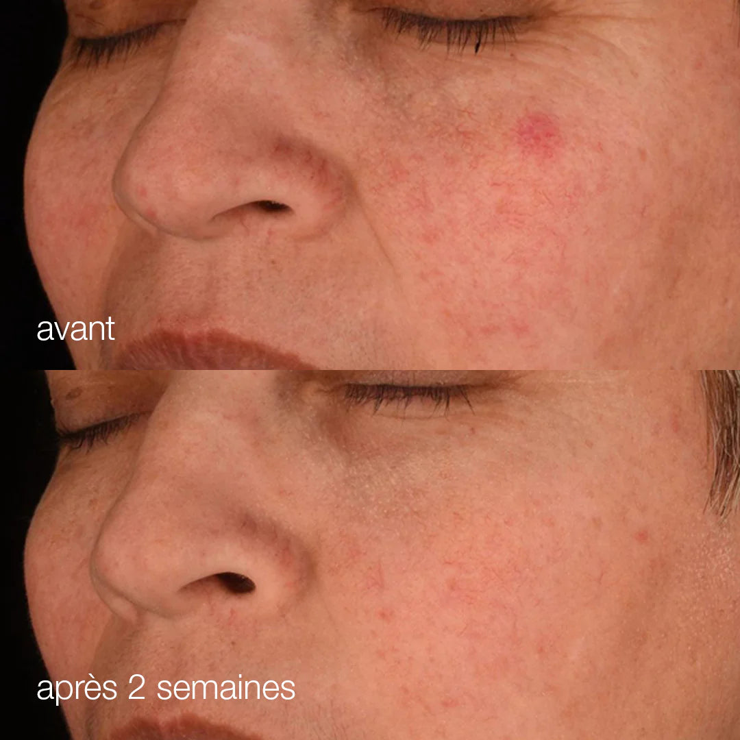 Avant après - Sérum anti-âge Dermalogica - Marine Lemaitre Skincare - Soin peau Nantes 