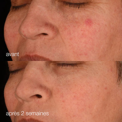 Avant après - Sérum anti-âge Dermalogica - Marine Lemaitre Skincare - Soin peau Nantes 